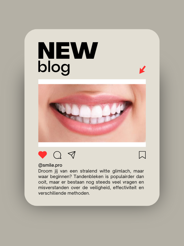 De Ultieme Gids voor Tandenbleken – Alles Wat Je Moet Weten
